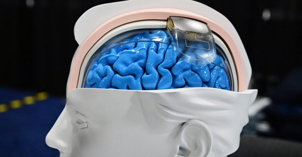 Brain tech revolution: How new neural devices are treating depression and more