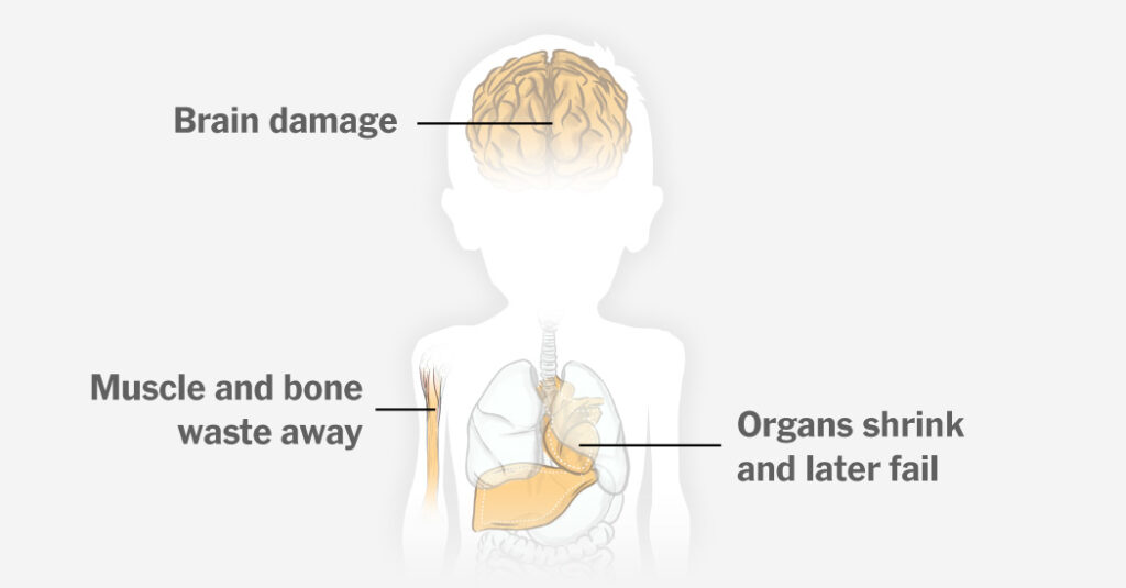 For Gaza's Children, Acute Malnutrition Could Cause a Lifetime of Health Challenges